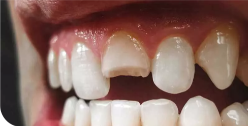 Urgent Tooth Help
