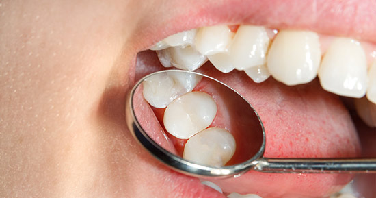 White Fillings Castle Hill