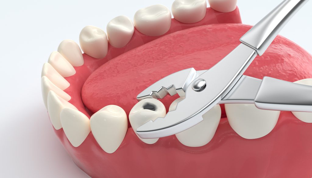 Tooth care at catle hill smiles