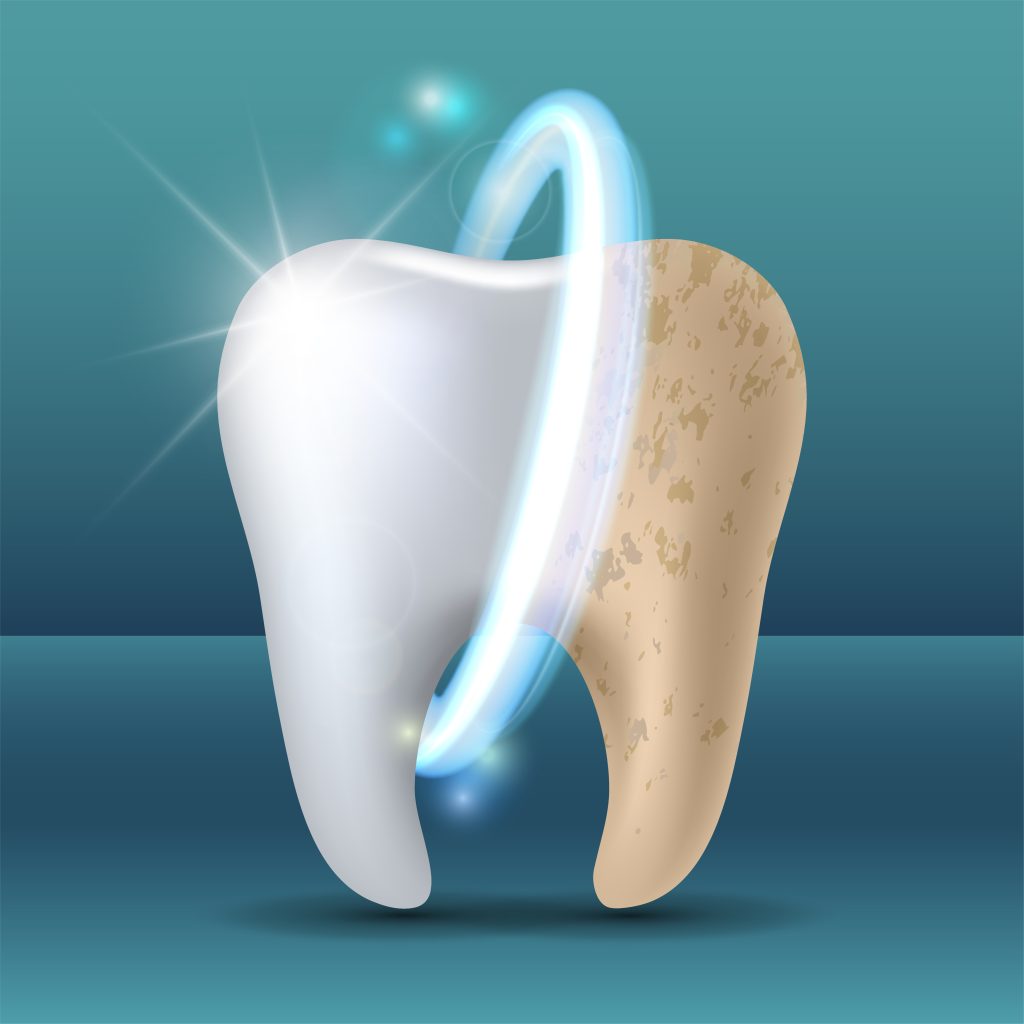 Tooth Restoration at castle hill smiles