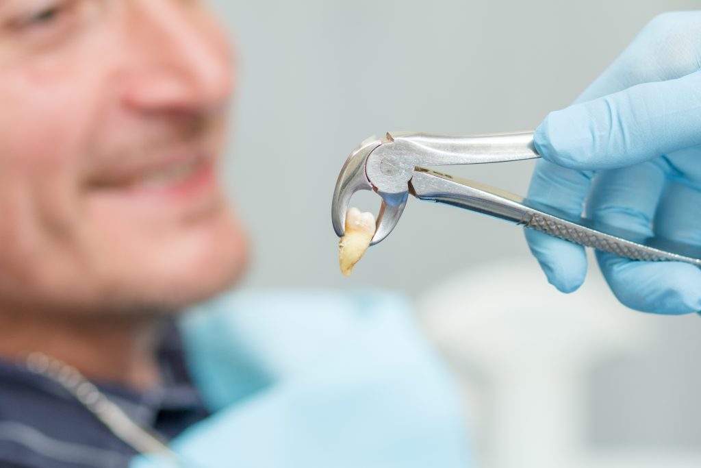 Dental extraction at catle hill smiles