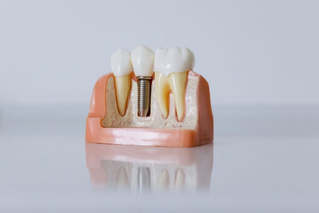 Understanding Dental Implants: A Comprehensive Guide