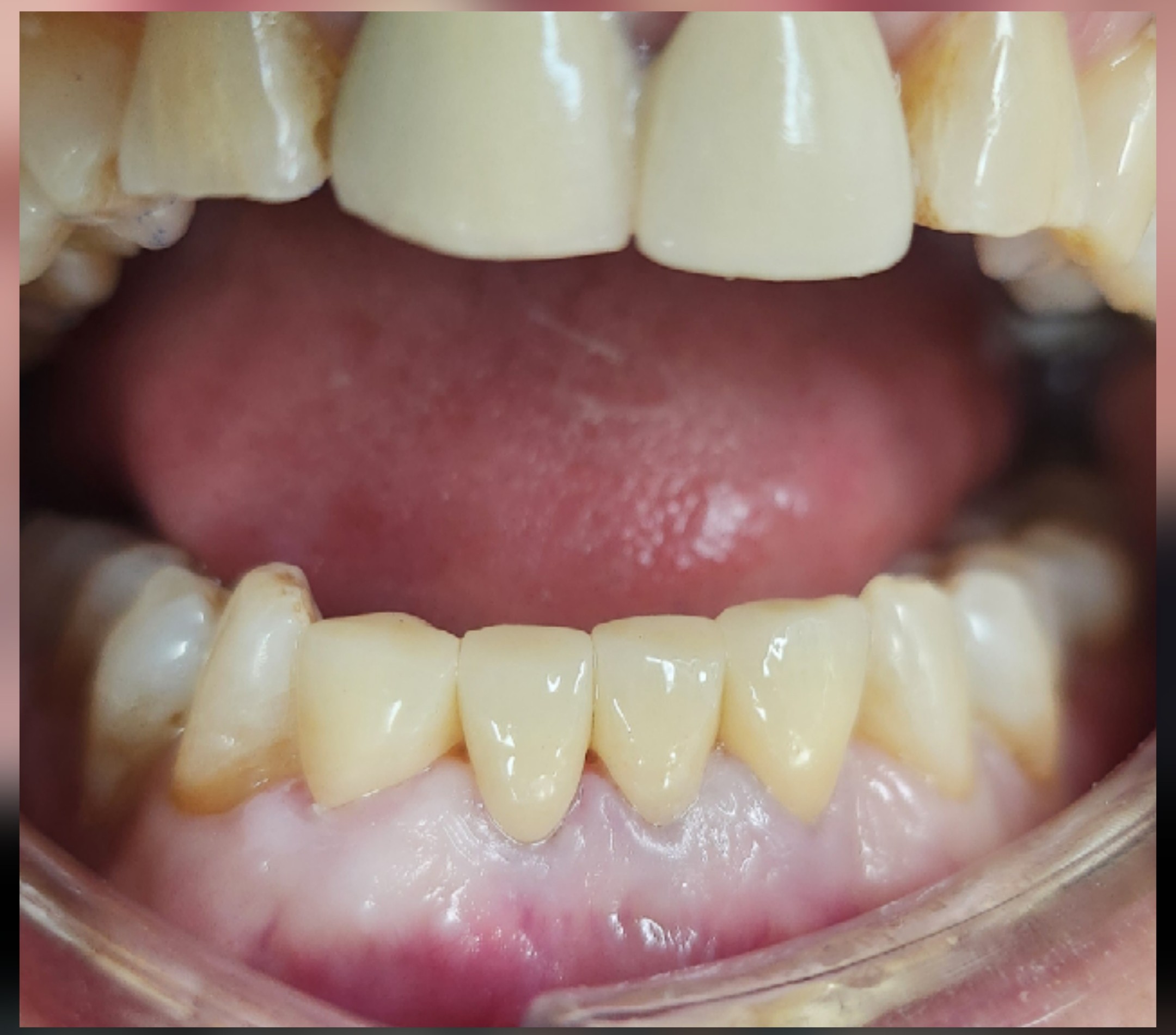 beautiful smile-after