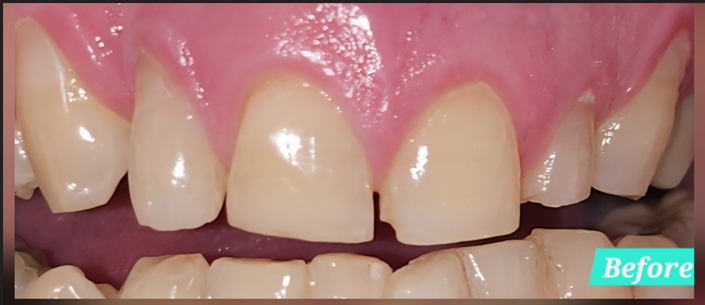 chipped_teeth