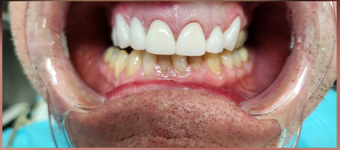 chipped_tooth_after