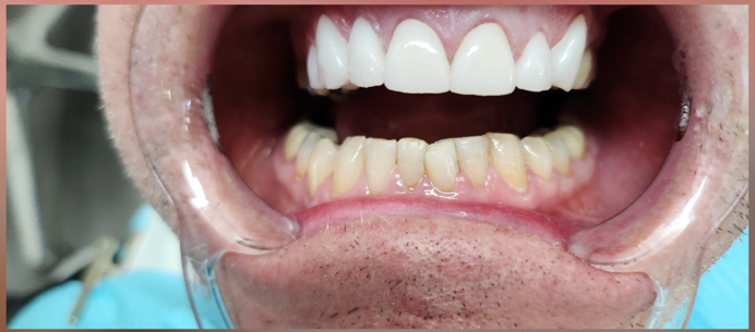 chipped_tooth_after_a