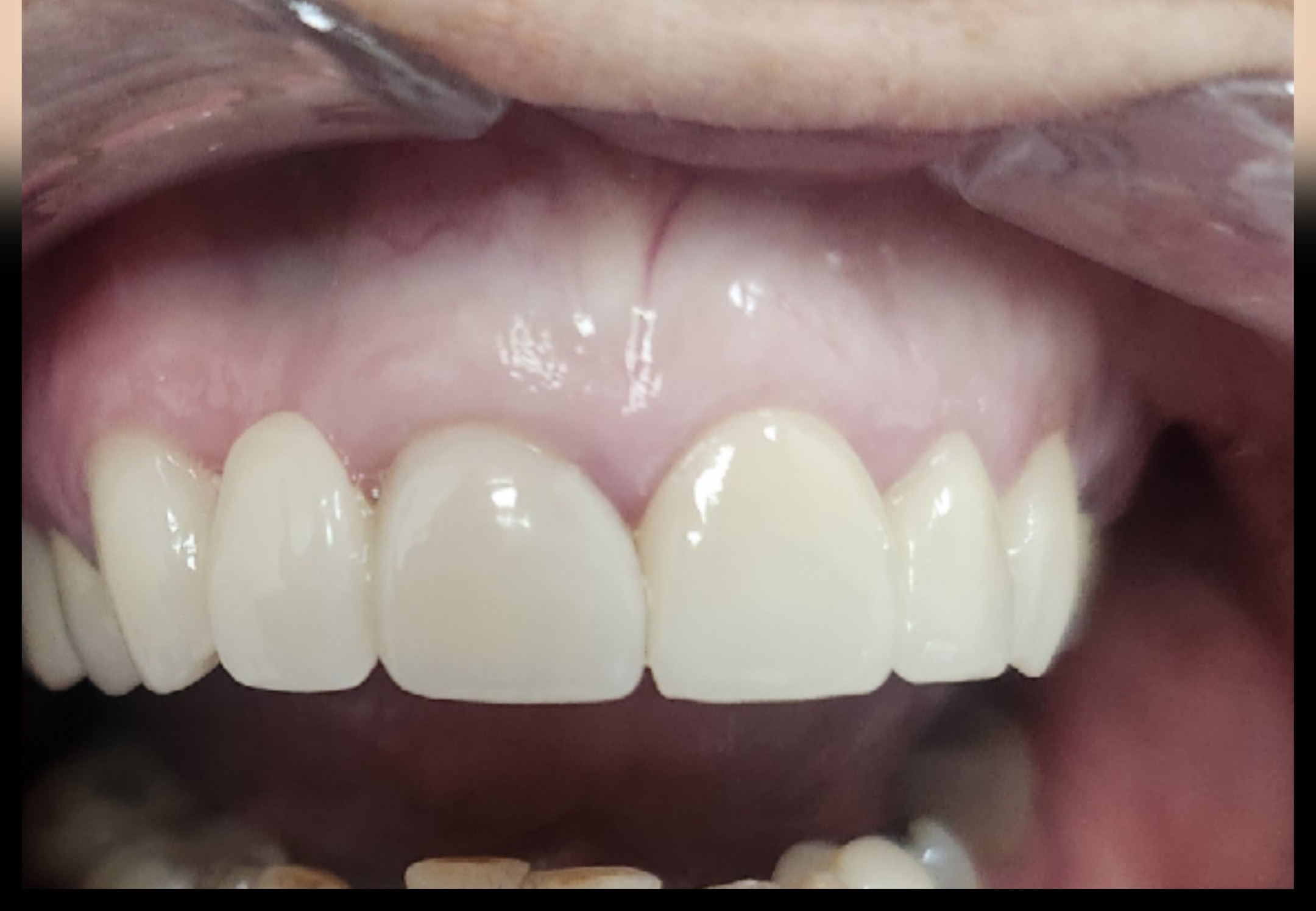 composite bonding-after