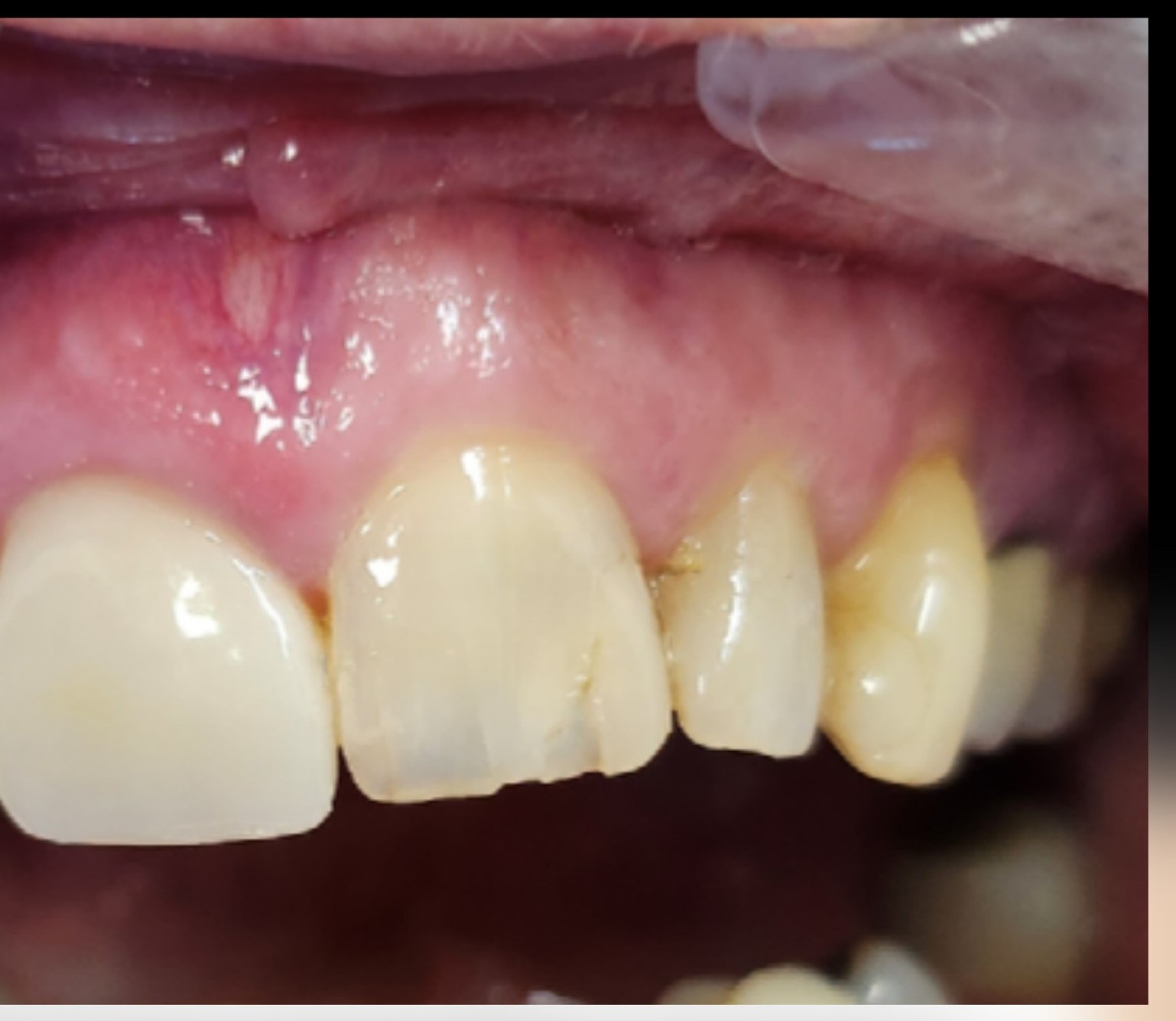 composite bonding-before