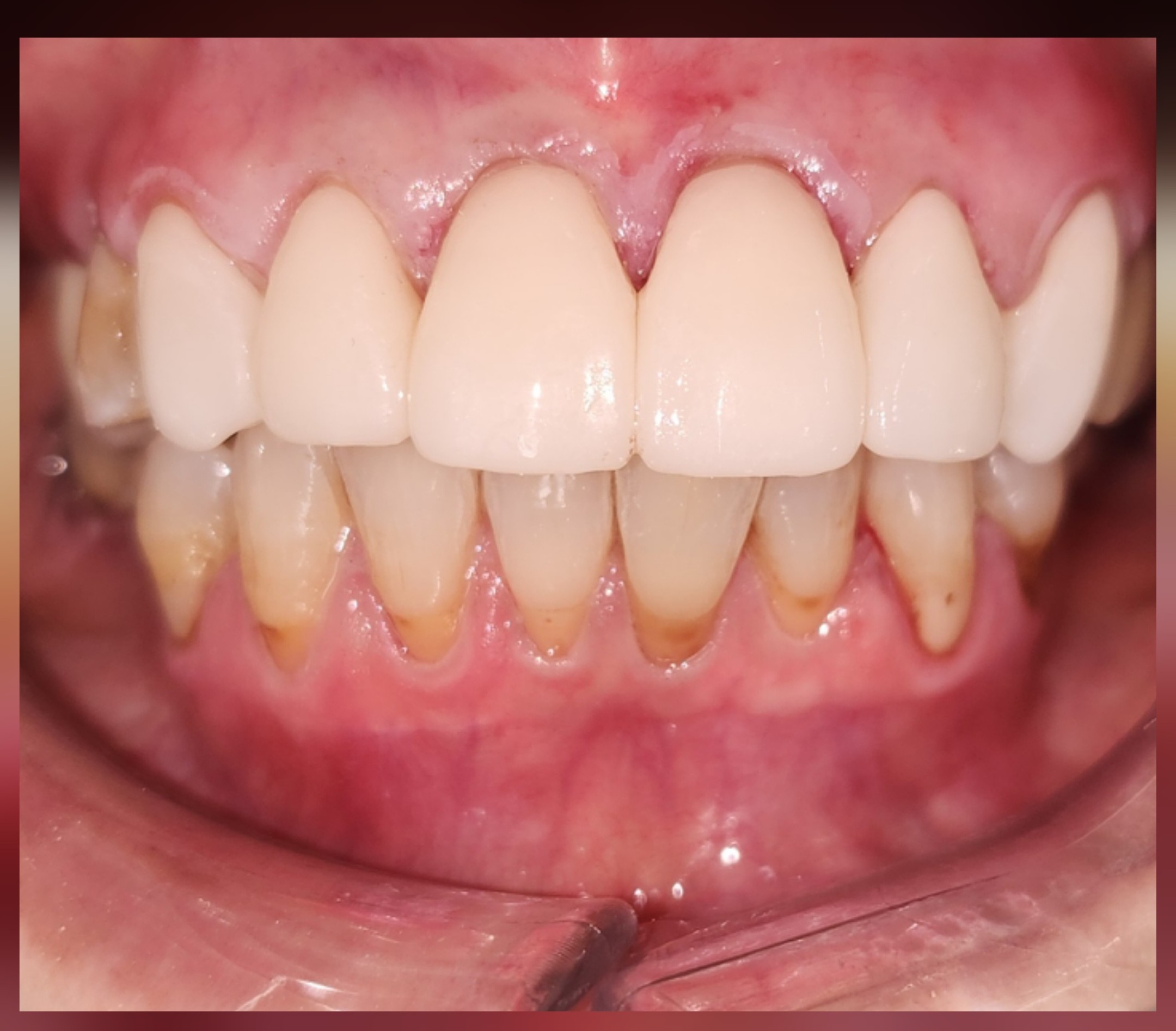 professional whitening-after