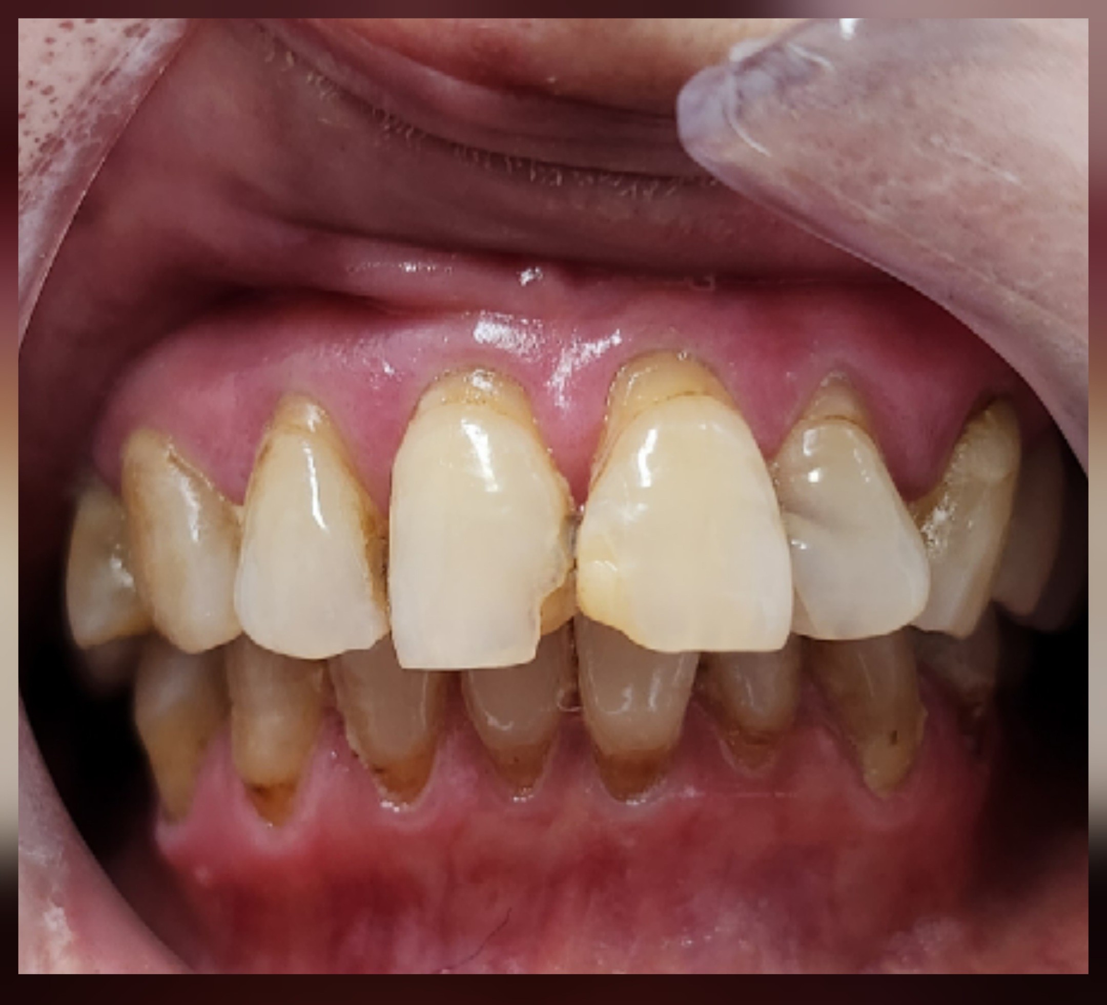 professional whitening-before