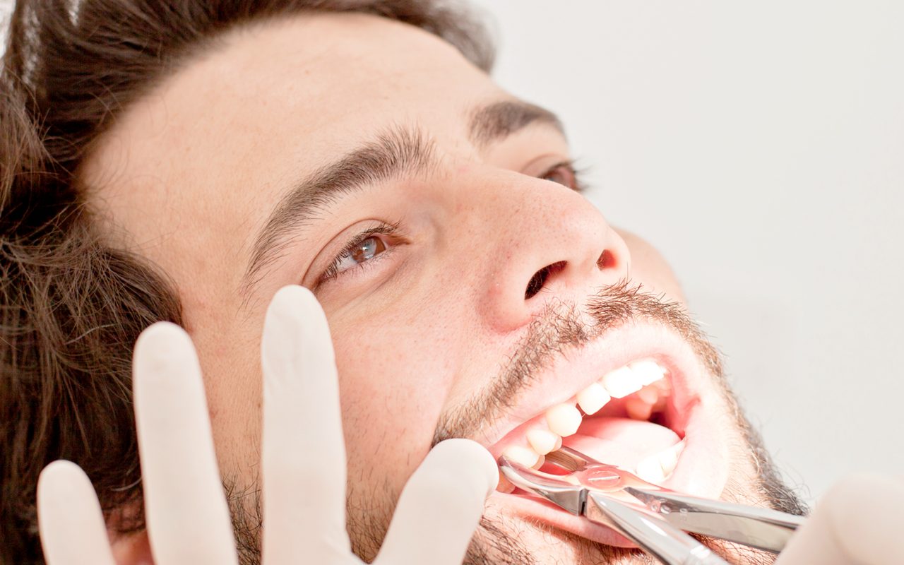 Wisdom Tooth Care at castle hill smiles